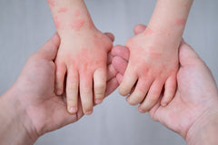 Common Types of Allergies in Babies and Kids: What Parents Need to Know