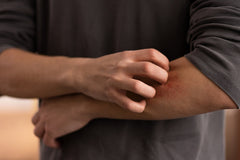 Eczema Flaring Up Again? These Triggers Might Be Why